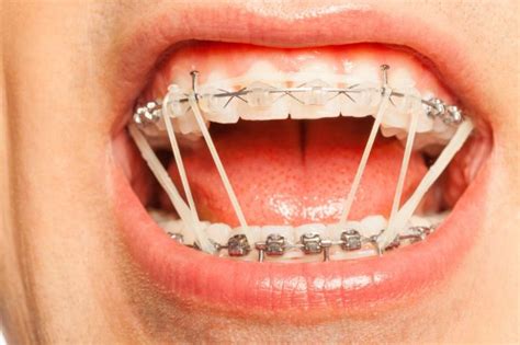 How Do Elastic Bands Work On Braces Divina Yoon