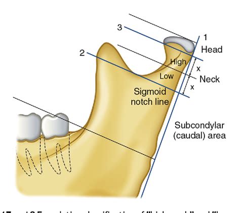 Mandibular Condyle Fracture