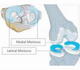 Medial Meniscus Tear Therapy Images