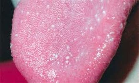 Small Bumps On Tongue Could Be Latest Coronavirus Symptom Doctors Warn