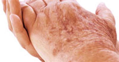 Removing Age Spots From Hands Ehow Uk