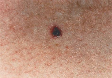 Melanoma Pictures By Stages Stage Melanoma Pictures