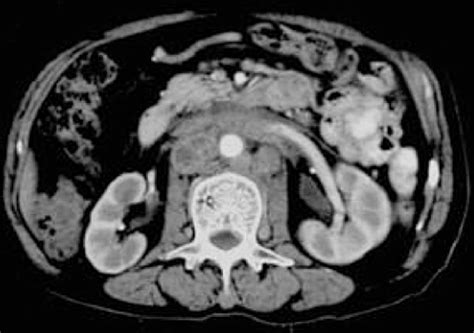 Pt With Retroperitoneal Lymph Node Involvement Multiple Enlarged Lymph