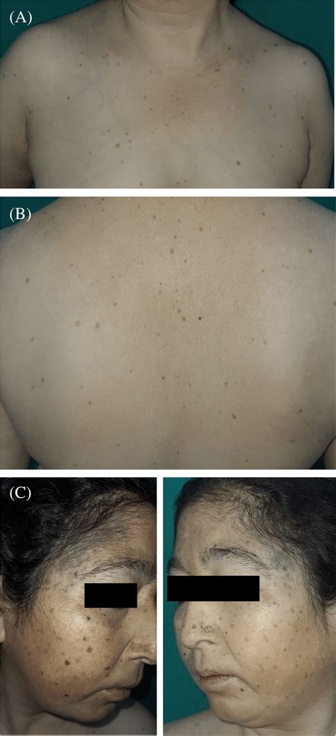 A Generalized Hypopigmentation Along With Hyperpigmented Macules B