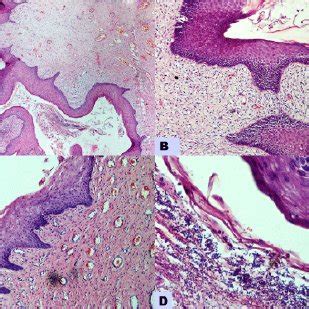 Pdf Fibroepithelial Polyp Of The Vagina With Fungal Infection Case