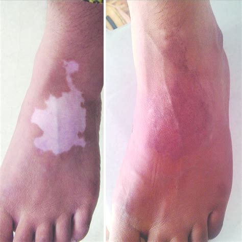 A Vitiligo On Foot In Group B Patient B Excellent Response After