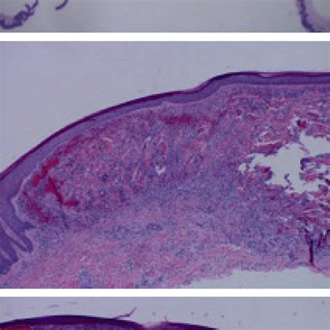 Histopathology Of Aneurysmal Dermatofibroma There Are Fibroblast