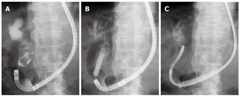 Direct Cholangioscopy Combined With Double Balloon Enteroscope Assisted