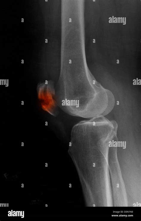 X Ray Showing A Fracture Of The Patella Kneecap Stock Photo Alamy
