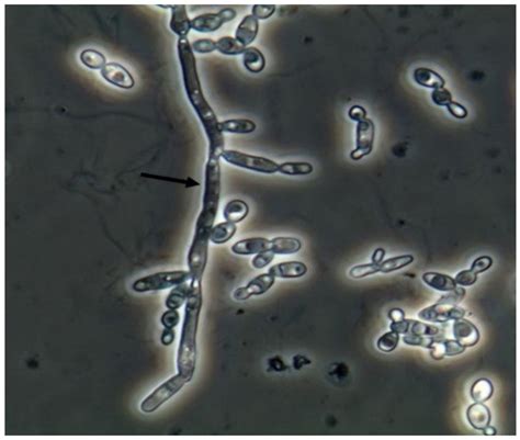 Candida Albicans Pseudohyphae In The Fresh And Unstained Urine