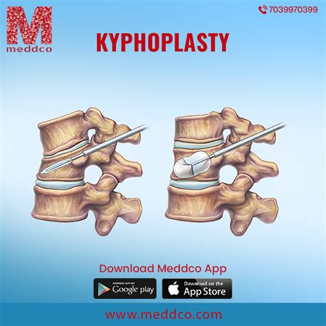 Procedures For The Treatment Of Kyphoplasty