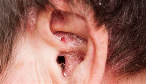 What Causes Flaky Skin Behind Ears Agnew Youbtlears