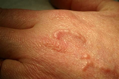 Granuloma Annulare Pictures In High Resolution And Clinical Information