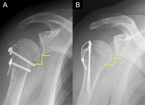 Radiographic Assessment Of Inferior Subluxation Of The Humeral Head A