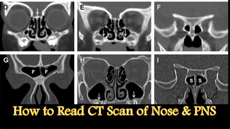 Nose And Paranasal Sinus Ct Scan । How To Read । Coronal Axial