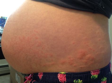 Pruritic Urticarial Papules And Plaques Of Pregnancy