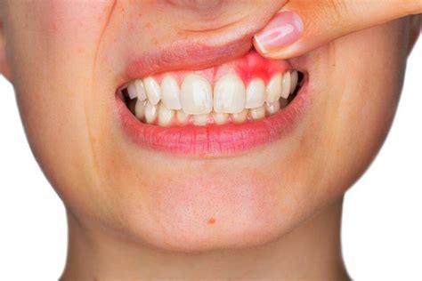 Home Remedies Against Inflamed Gums 5 Practical Tips Womens Alphabet