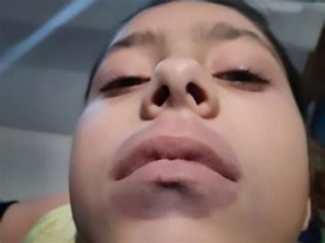 Kylie Jenner Lip Challenge Leads To Girls Shock Diagnosis 7news