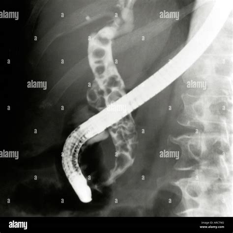 Ercp Hi Res Stock Photography And Images Alamy