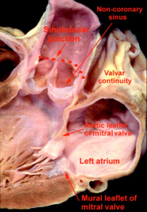 Clinical Anatomy Of The Aortic Root Heart
