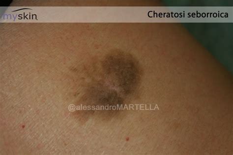 Verruca seborroica: cosa fare | Myskin - Dermatologi Online