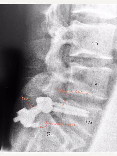 Pars Defect Repair Spines Dorset