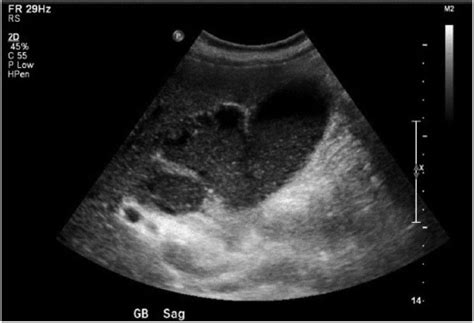 Sonographic Findings Of Gallbladder Perforation With Hepatic Abscesses
