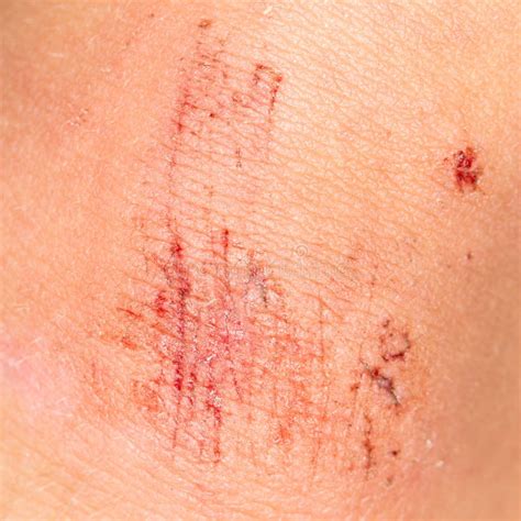 Wound On The Skin Close Up Stock Image Image Of Accident Flesh