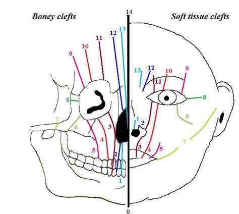 Facial Cleft Encyclopedia Mdpi