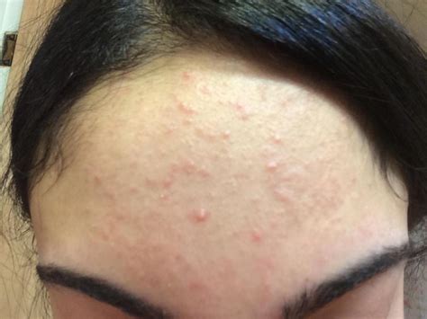 What Are These Small Slightly Red Bumps On My Forehead General Acne