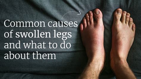 Common Causes Of Swollen Legs And What To Do About Them