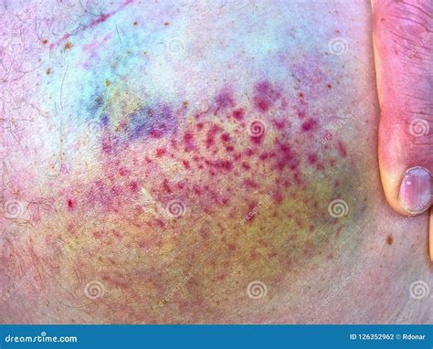 Purple Bruise On The Skin Close Up View Colorful Hematoma Stock