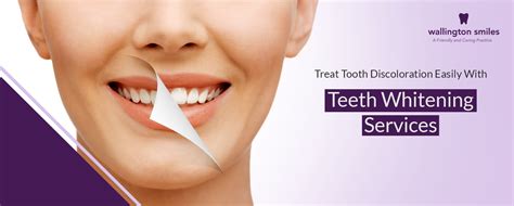 Treat Tooth Discoloration With Teeth Whitening Services