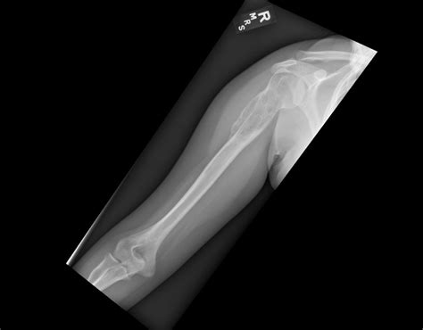 Pathology Outlines Aneurysmal Bone Cyst