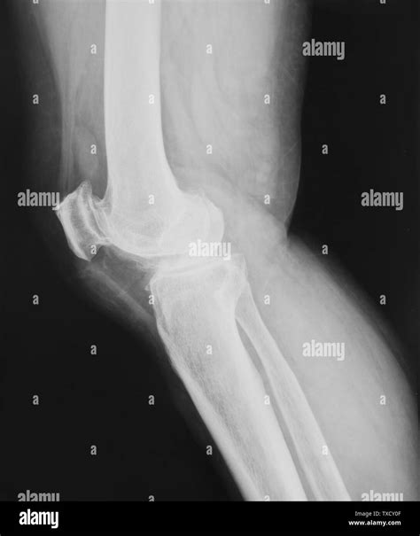 Normal Knee X Ray Hi Res Stock Photography And Images Alamy