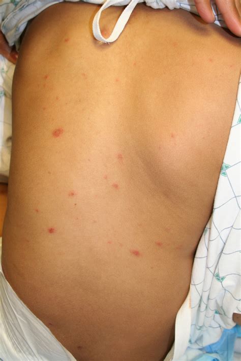 Streptococcus Skin Infection Pictures Photos