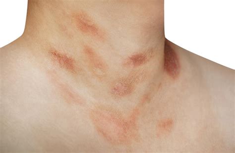 These include diphenhydramine (benadryl, others). Psoriasis vs. pityriasis rosea: Symptoms and causes