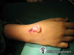 Hand Ganglion Cyst Excision Dorsal Removing A Ganglion Cyst This Hot