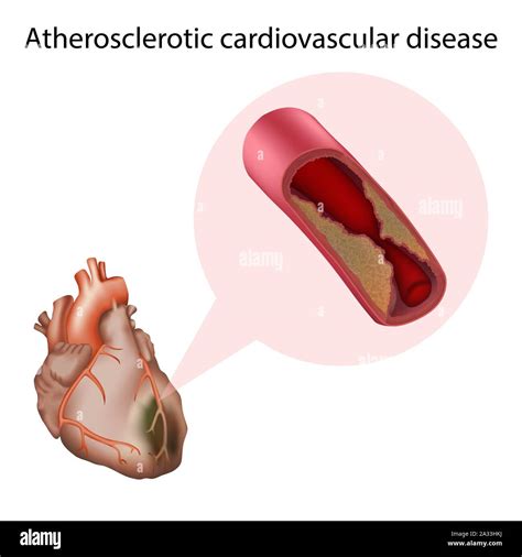 Atherosclerotic Cardiovascular Disease Illustration Stock Photo Alamy