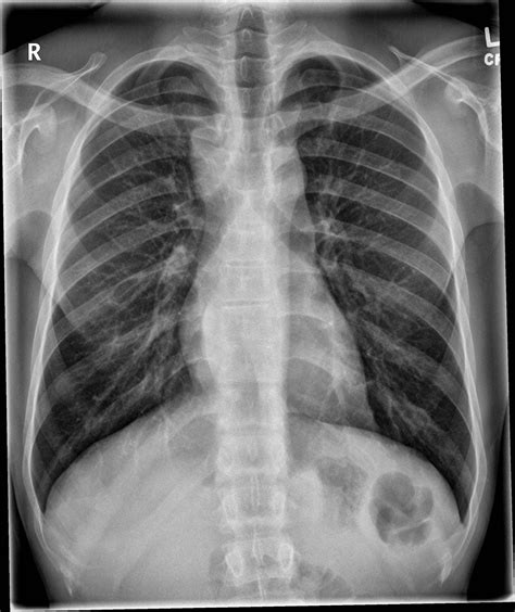 Broken ribs — comprehensive overview covers symptoms, causes and treatment of rib bone fractures. Pin by Sulaiman Alhassan on Signs | Rib fracture ...