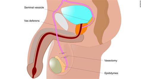 Male Reproductive System And Vasectomy Diagrams Sexiz Pix