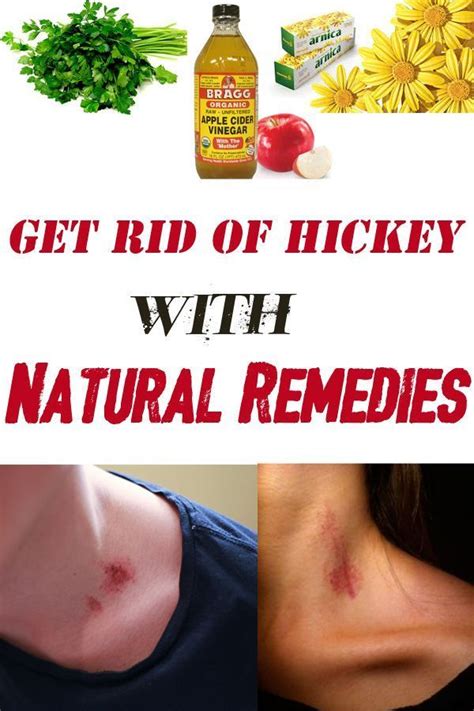 how to get rid of hickey with natural remedies remedies natural remedies home remedies for hair