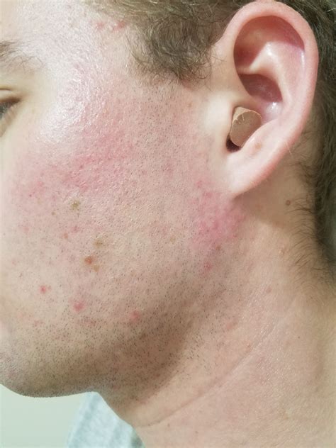 Pictures Rash That Doesnt Itch And Is Not Dry Rosacea And Facial
