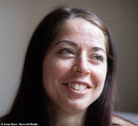 Personal Trainer Who Had The Worst Acne Ever Seen Shares Her Striking