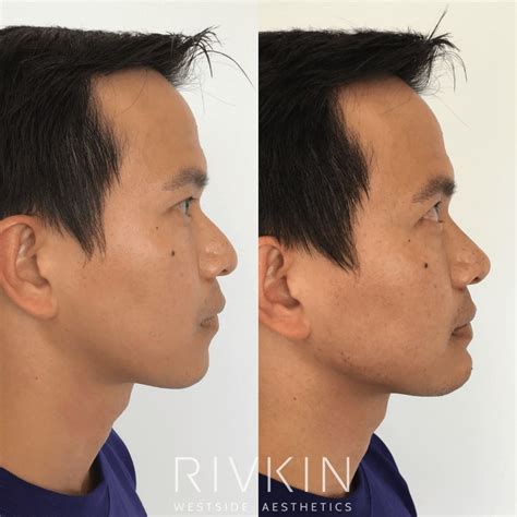 Asian Nose Rivkin Aesthetics