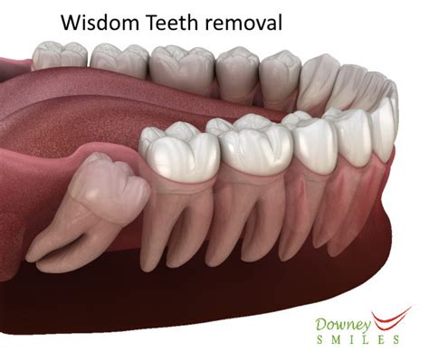 Wisdom Teeth Removal Oral Surgery For Impacted Molars Age Pain