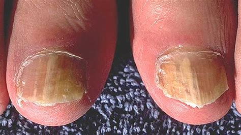 Nail Psoriasis Pictures Symptoms And Treatments