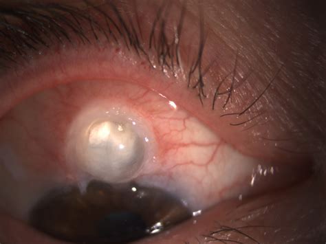 This Post Trabeculectomy Bleb Glaucoma Advanced Eye Surgery