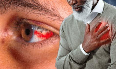 Heart Attack Symptoms Signs In The Eyes Such As Dilated Vessels Can