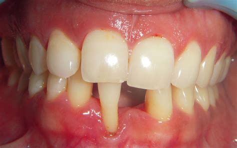 Treated Cases Periodontal Abscess Restore Dental Treatment Centre